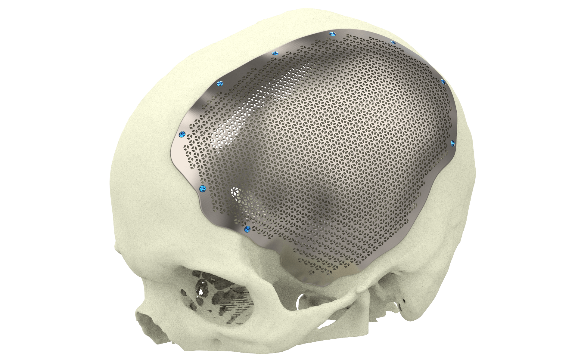 Modelos 3D en neurocirugía